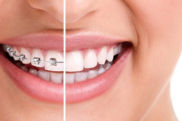 انواع درمان ارتودنسی