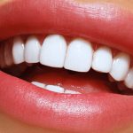 لمینیت و ونیر دندان در مطب دکتر طاهره حکام زاده | طراحی لبخند حرفه‌ای ویژه جشنواره عیدانه