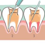 همه چیز درباره درمان ریشه دندان بدون عصب کشی