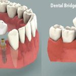 ایمپلنت یا بریج کدام بهتر است | هر آنچه باید بدانید