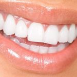 مزایای کامپوزیت ips که باید بدانید