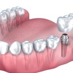 ایمپلنت چندتایی چیست؟