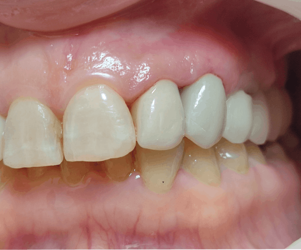 zirconia (1)