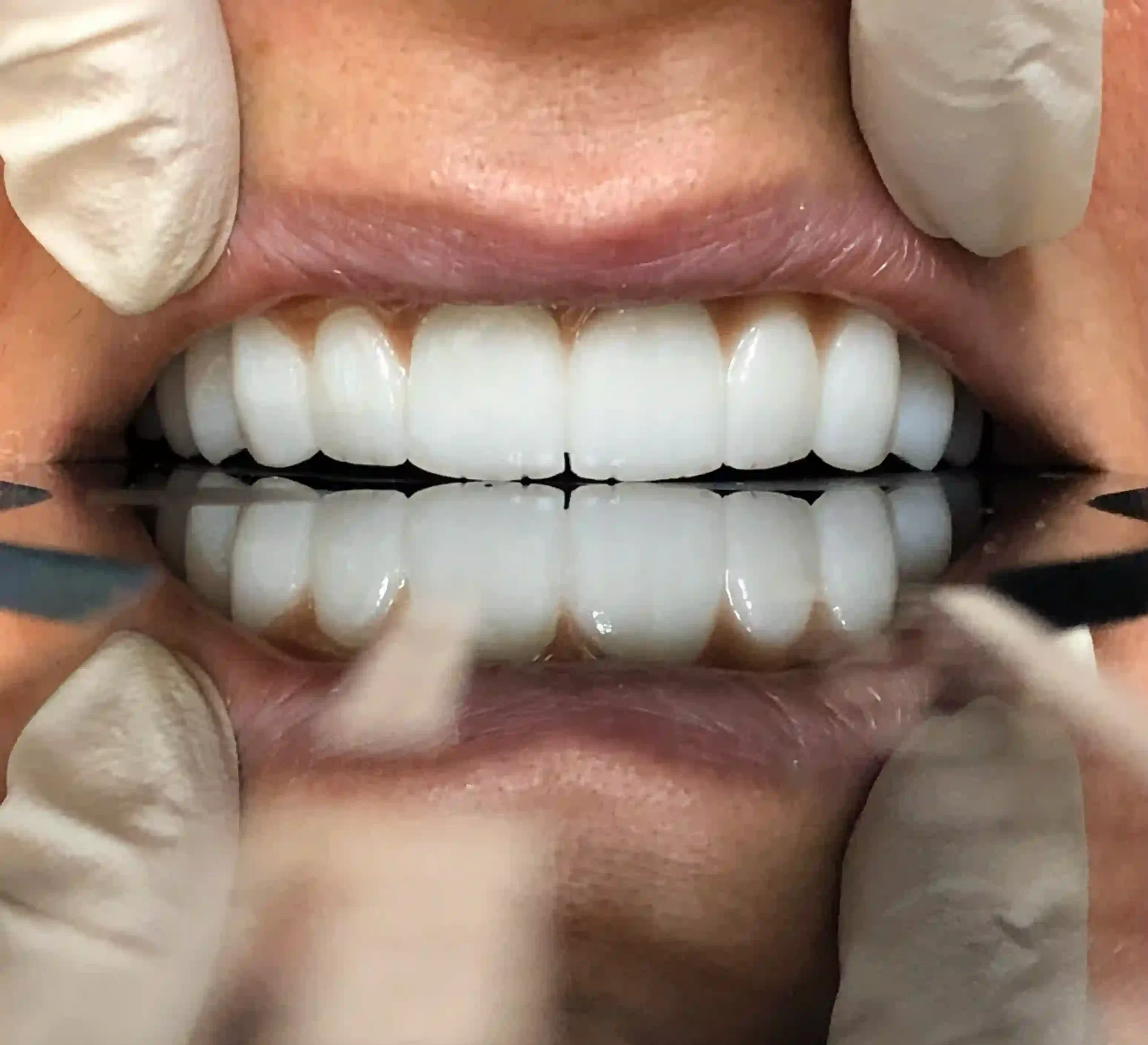 پروتز ایمپلنت