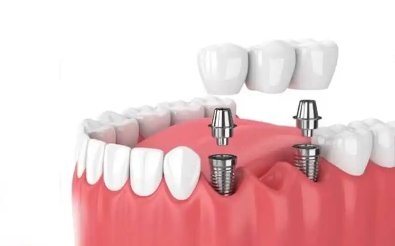 پروتز ایمپلنت