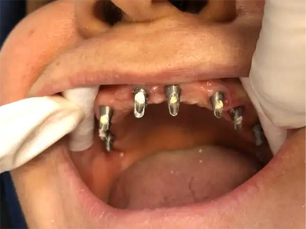 پروتز ایمپلنت