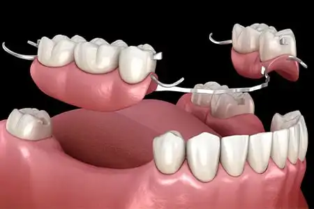 پروتز متحرک